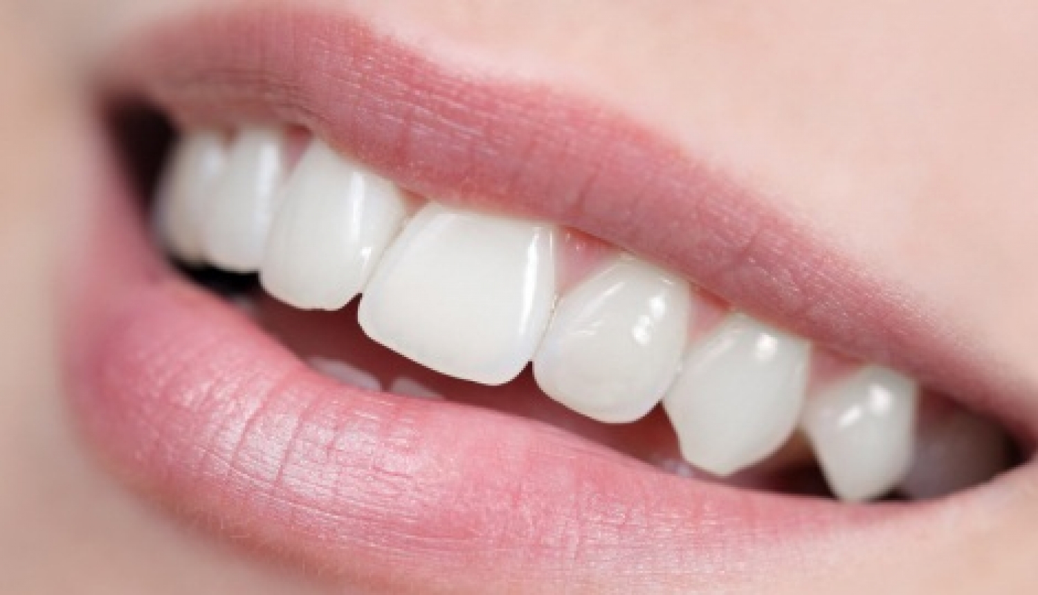 Astuces-naturelles-pour-des-dents-blanches